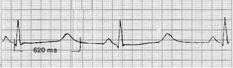 Синдром удлиненного интервала QT: полное руководство по жизни без риска