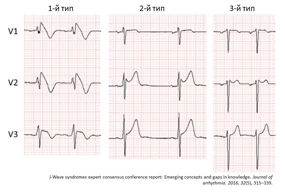 Синдром Бругада: полное руководство по жизни с редким заболеванием сердца