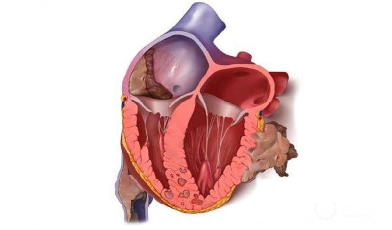 Миксома сердца: полное руководство по диагностике, лечению и прогнозу