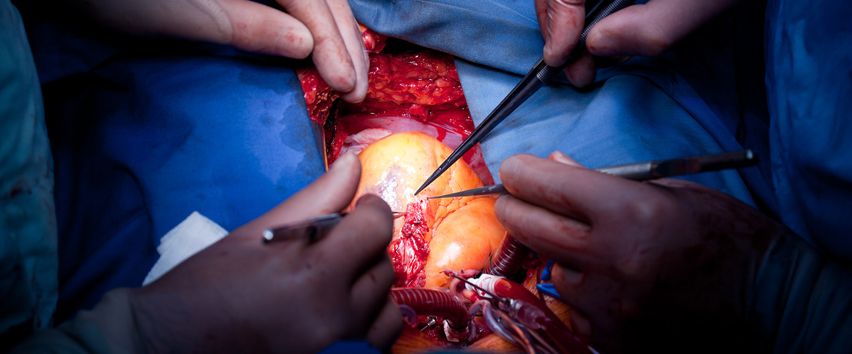 Аортокоронарное шунтирование для восстановления кровотока в сердце