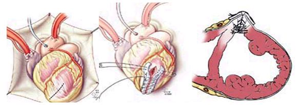 Аневризма левого желудочка: полное руководство по лечению и прогнозу