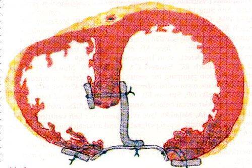 Постинфарктный дефект МЖП: современная кардиохирургия для спасения жизни