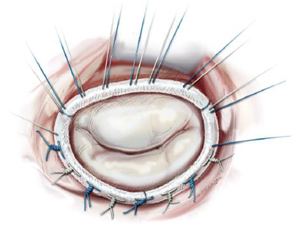 Стеноз митрального клапана: найти путь к здоровому сердцу и полноценной жизни