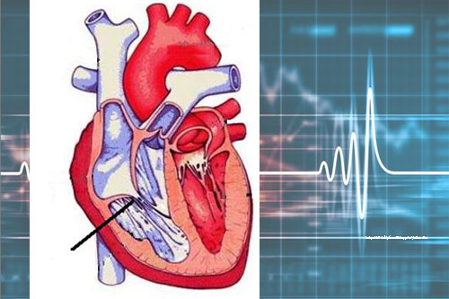 Стеноз трикуспидального клапана: обрести здоровье сердца через лечение