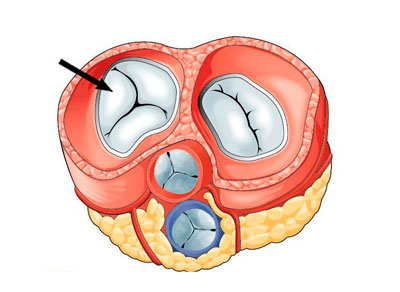 Недостаточность трикуспидального клапана: от диагноза до кардиохирургии