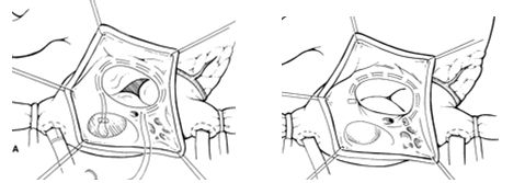 Пластика трикуспидального клапана: возвращение к здоровой работе сердца