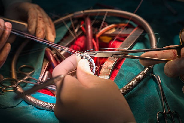 Протезирование трикуспидального клапана: возвращение к здоровой жизни