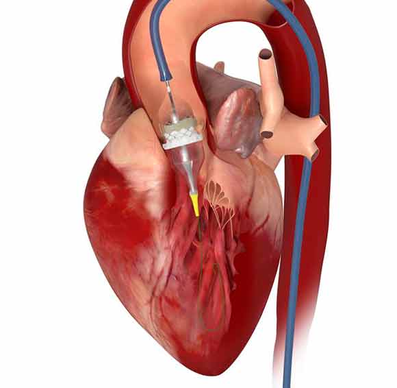 Недостаточность клапана легочной артерии: от диагностики до кардиохирургии