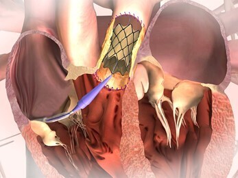 Восстановление здоровья сердца через замену клапана легочной артерии