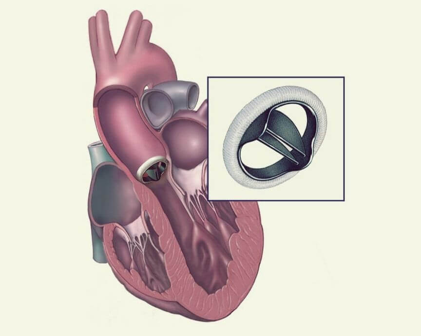 Дисфункция протеза клапана сердца: полное руководство для пациента