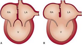 Единственный желудочек сердца: полное руководство по диагностике и лечению