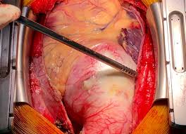 Протезирование корня аорты для восстановления здоровья сердца и сосудов