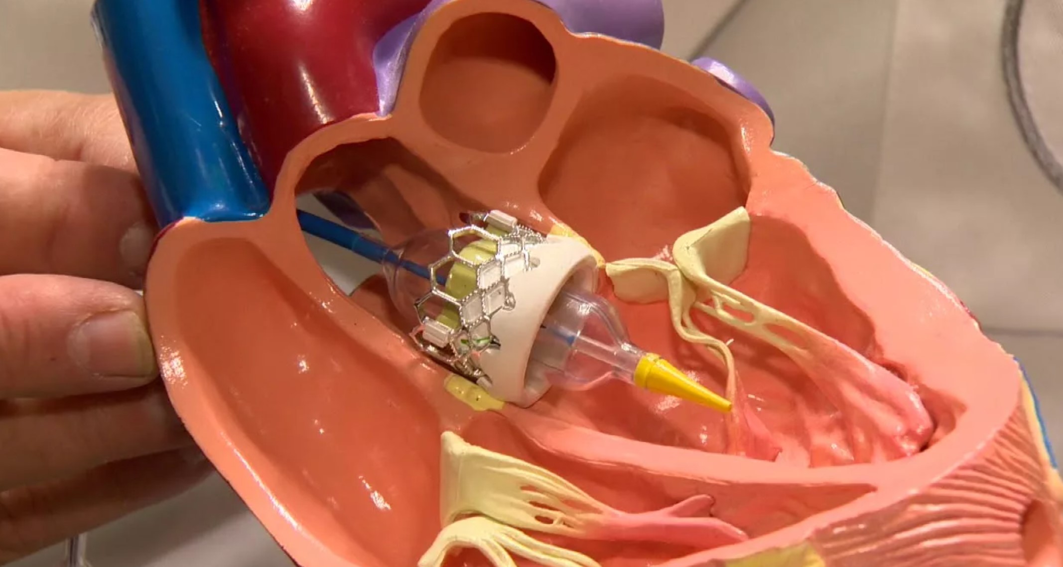 Восстановление работы сердца без разреза грудины: полное руководство по TAVI