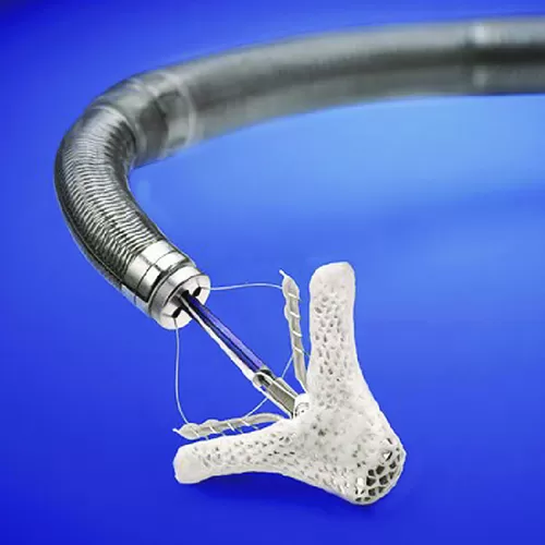 Транскатетерная пластика MitraClip для восстановления митрального клапана