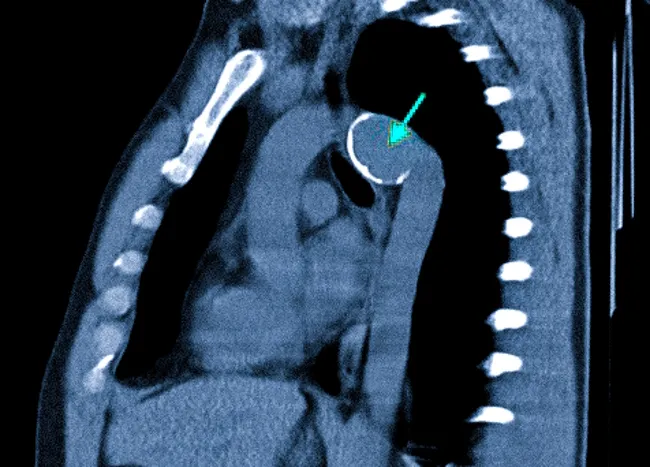 Аневризма дуги аорты: полное руководство по диагностике, лечению и жизни после