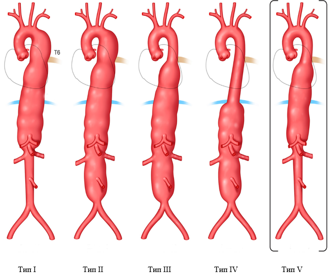 Торакоабдоминальная аневризма аорты: путь от диагноза до полного восстановления