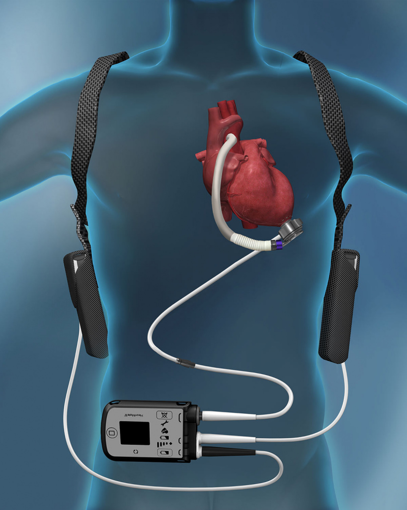 Искусственный желудочек сердца (LVAD) для продления и улучшения качества жизни