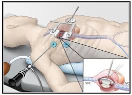 Операция Морроу: избавление от симптомов гипертрофической кардиомиопатии