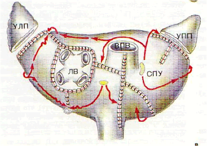 Хирургическое лечение фибрилляции предсердий для восстановления ритма сердца