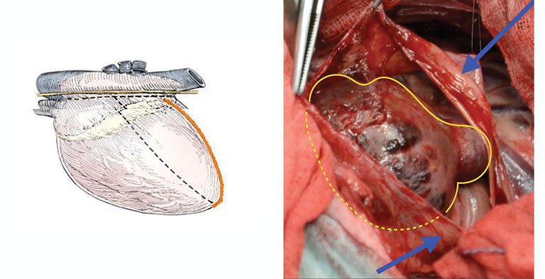 Перикардэктомия: полное руководство по операции на сердце и восстановлению