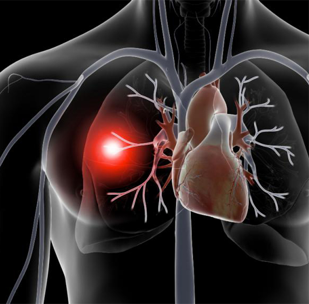 Операция при тромбоэмболии легочной артерии: ваш путь к восстановлению