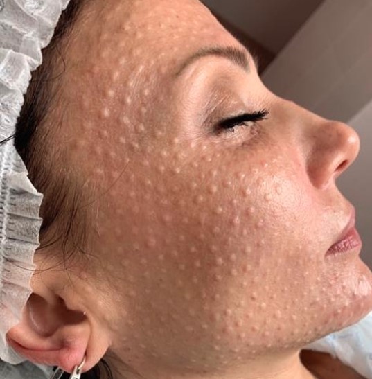 Мезотерапия: полное руководство по омоложению и решению проблем кожи