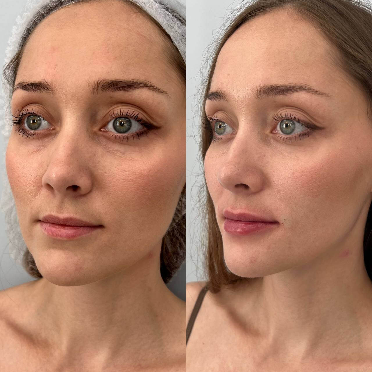 Контурная пластика лица: полное руководство по филлерам и омоложению