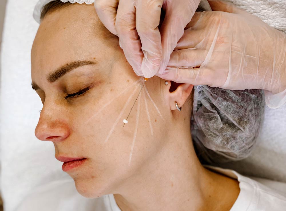 Нитевой лифтинг: полное руководство по безоперационной подтяжке лица и тела