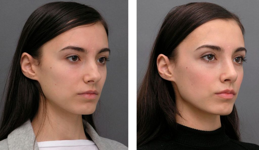 Инъекционная ринопластика: как изменить форму носа без операции и скальпеля