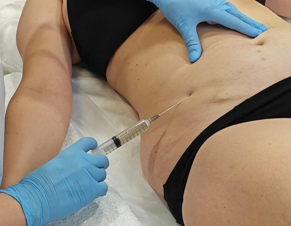 Инъекционные липолитики для коррекции фигуры и лица: полный гид по методу