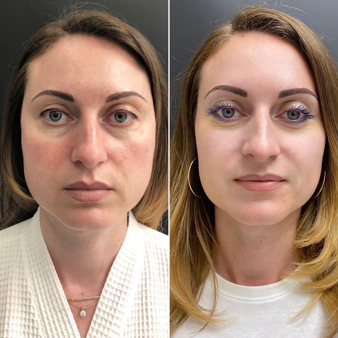 Фотоомоложение лица: как вернуть коже сияние и упругость с помощью света