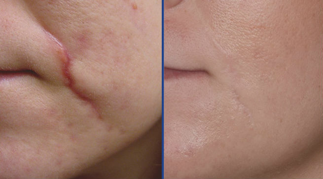 Эффективное удаление рубцов и шрамов: полный гид по методам косметологии