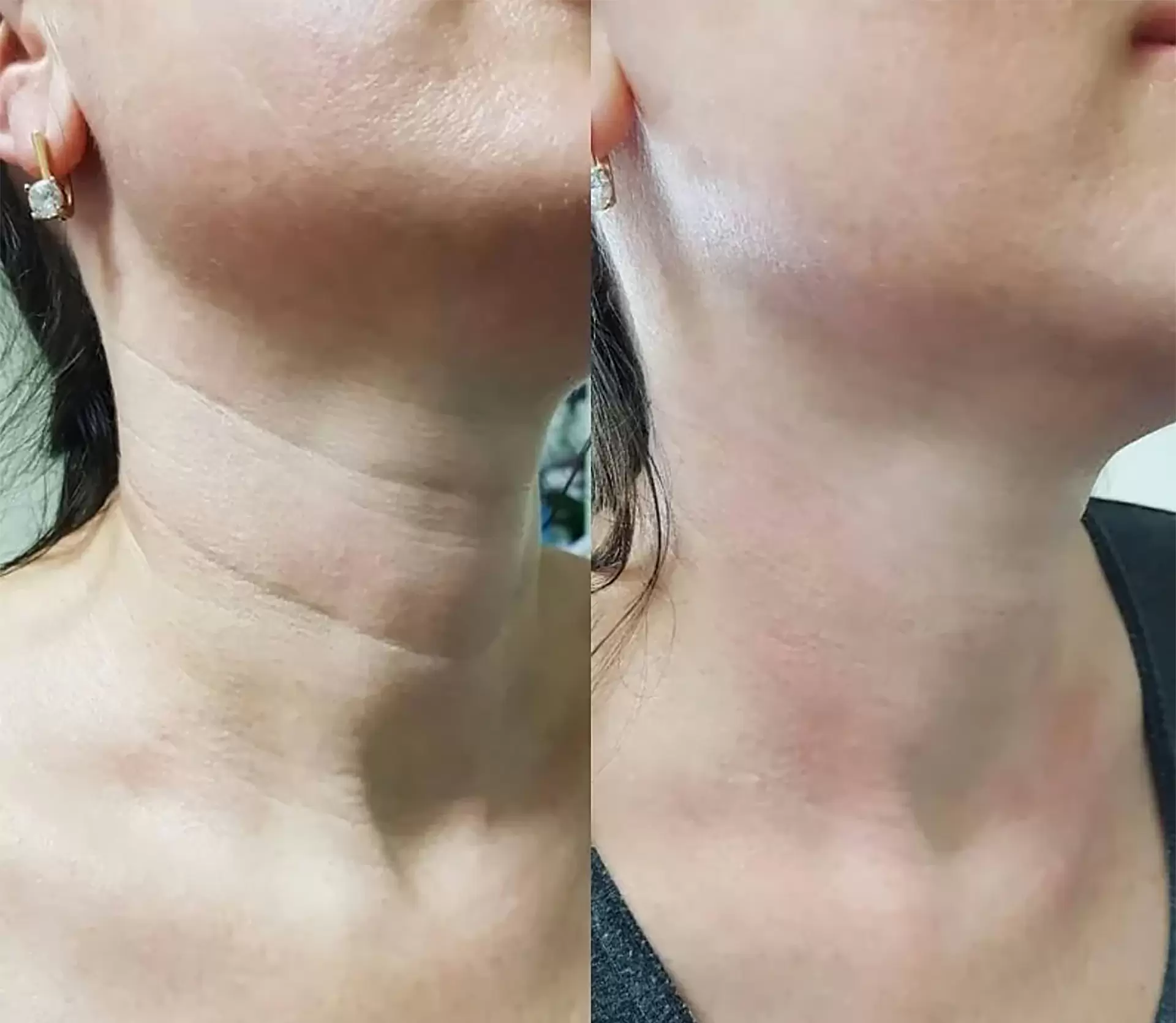 Избавиться от колец Венеры: полный гид по причинам и методам коррекции