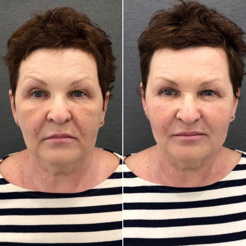 Коррекция овала лица: современные методы для возвращения четких контуров