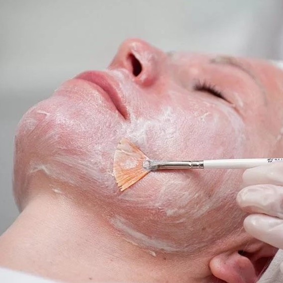 Салициловый пилинг: полное руководство по обновлению проблемной кожи