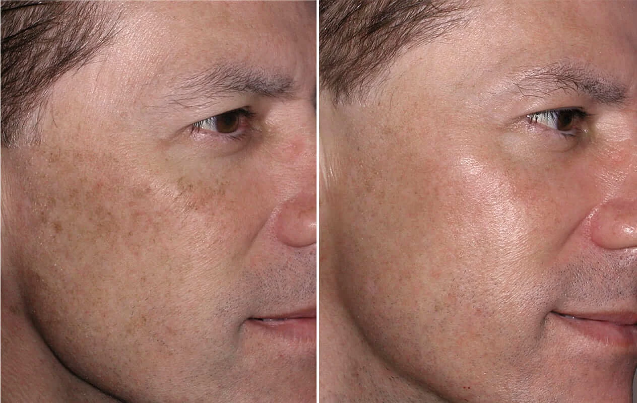 Пилинг PRX-T33: полное руководство по омоложению кожи без реабилитации