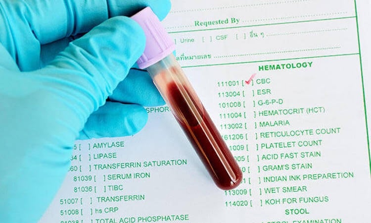 Анализ на ревматоидный фактор: полное руководство по нормам и отклонениям