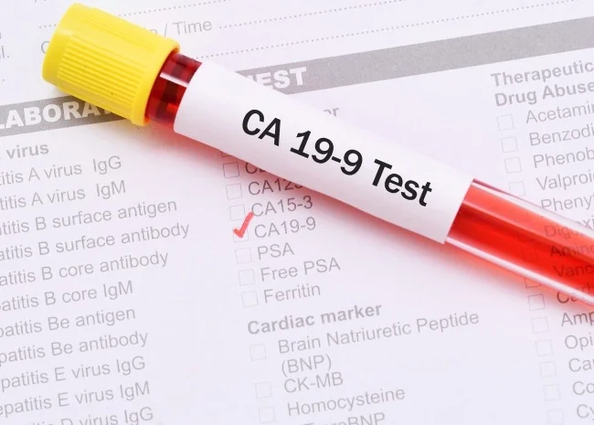 Онкомаркер CA 19-9: полное руководство по анализу и его значению в диагностике