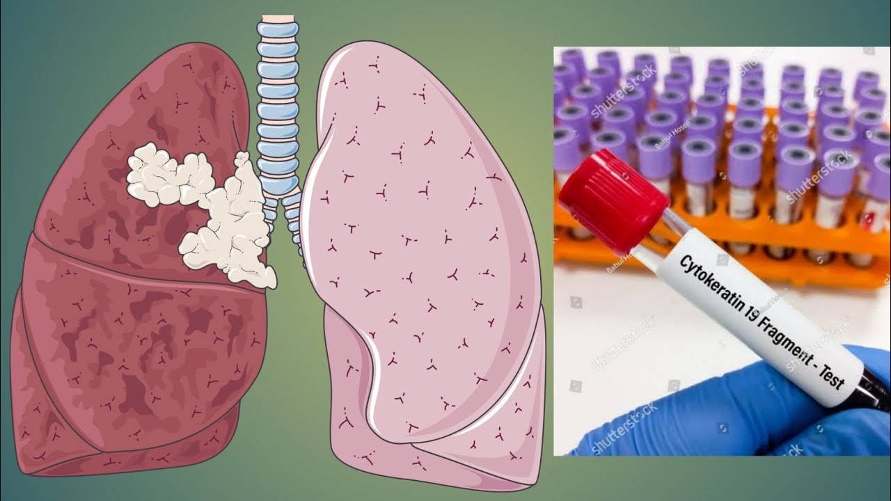 Онкомаркер Cyfra 21-1: полная информация об анализе для диагностики рака легкого