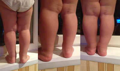 Восстановление правильной формы ног у ребенка с помощью лечебной физкультуры