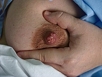 Трещины сосков: обрести комфорт при кормлении и защитить здоровье груди