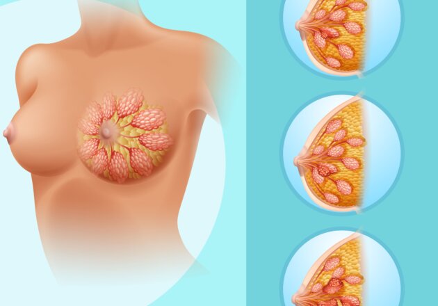 Жировой некроз молочной железы: полное руководство по причинам и лечению