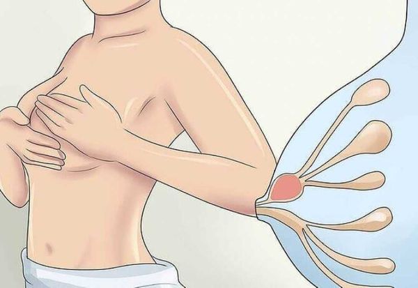 Абсцесс молочной железы: полное руководство по лечению и профилактике