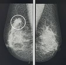 Радиальный рубец молочной железы: понять диагноз и принять верное решение
