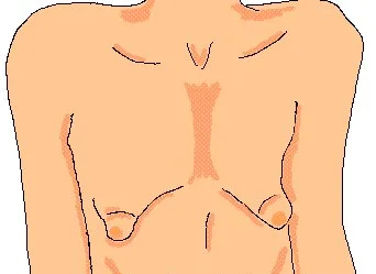 Тубулярная деформация груди: полное руководство по диагностике и коррекции