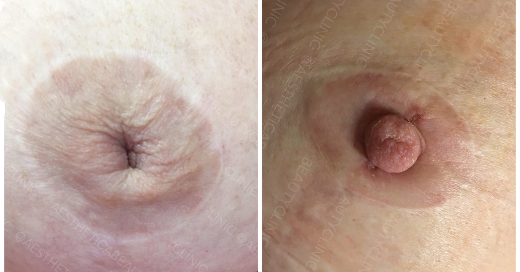 Втянутый сосок: полное руководство по причинам, диагностике и коррекции