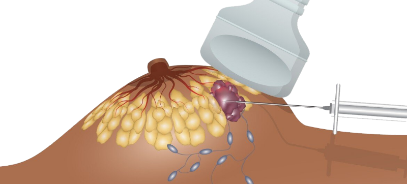 Тонкоигольная биопсия молочной железы: полное руководство по процедуре