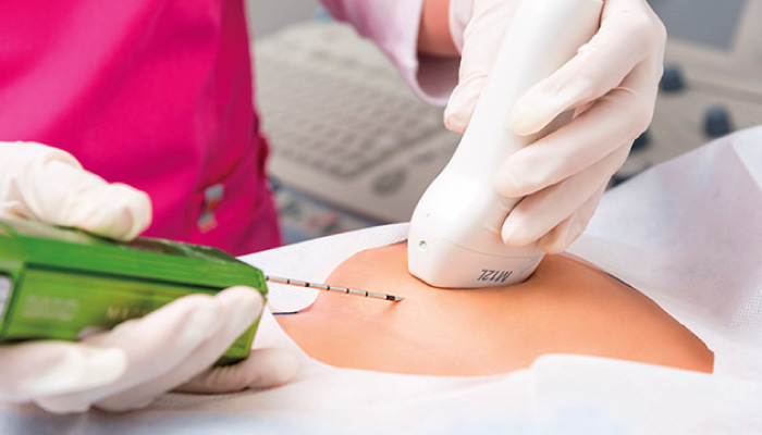 Трепан-биопсия молочной железы: полное руководство по процедуре для пациентов