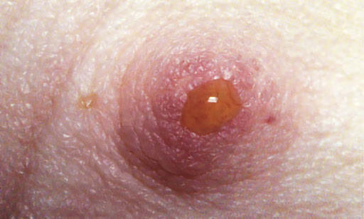 Цитологическое исследование выделений из соска для исключения патологий