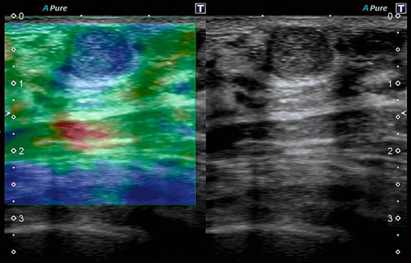 Эластография молочных желез: точная диагностика образований без биопсии